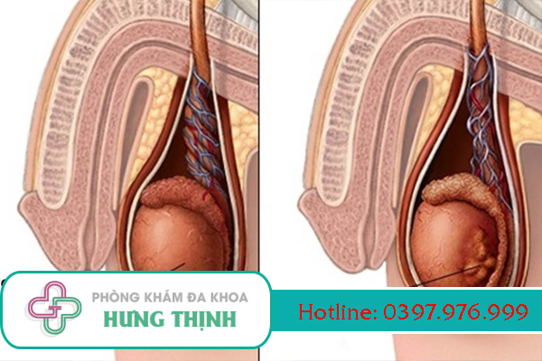 Sưng tinh hoàn là gì, nguyên nhân, triệu chứng, cách điều trị