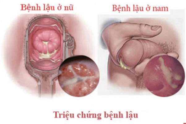 Bệnh lậu nguy hiểm như thế nào?