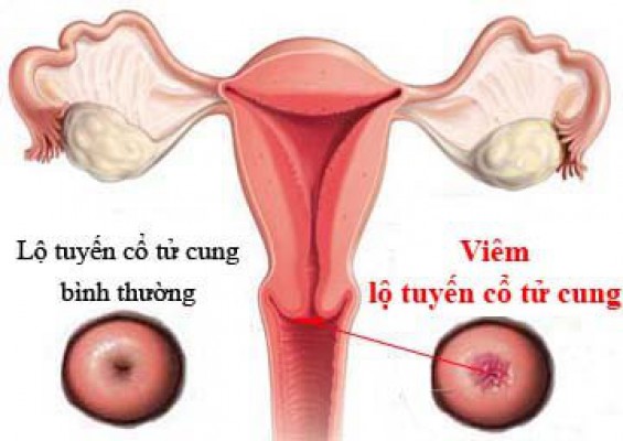 Đốt Viêm Lộ Tuyến Cổ Tử Cung