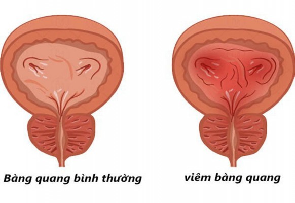 Viêm bàng quang: Tưởng đơn giản nhưng nguy hiểm vô cùng!