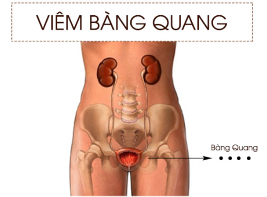  VIÊM BÀNG QUANG Ở NAM GIỚI CÓ NGUY HIỂM KHÔNG?