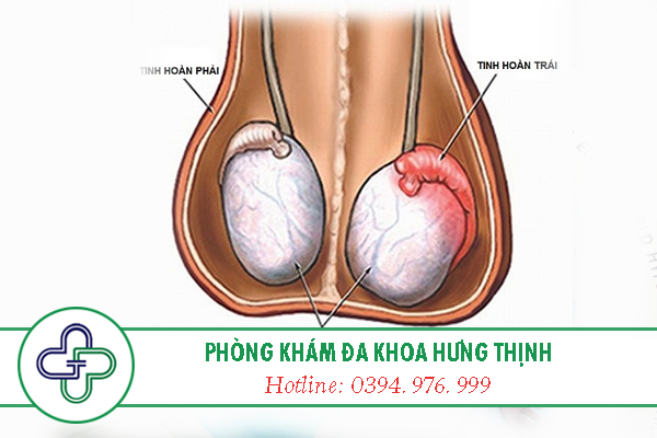 Viêm tinh hoàn chữa như thế nào?