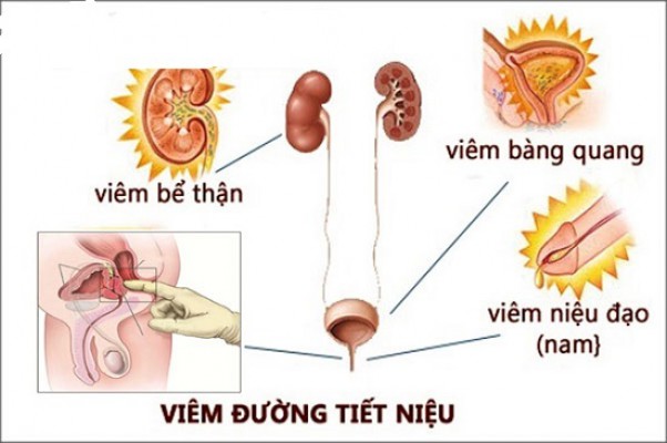 Những điều cần biết về viêm đường tiết niệu