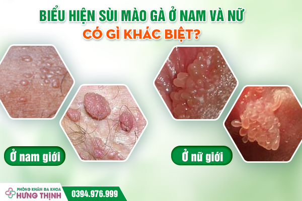 Biểu Hiện Sùi Mào Gà Ở Nam Và Nữ Có Gì Khác Biệt?