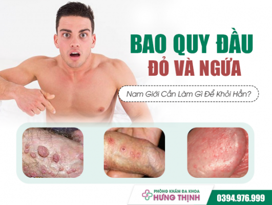 Bao Quy Đầu Đỏ Và Ngứa: Nam Giới Cần Làm Gì Để Khỏi Hẳn?