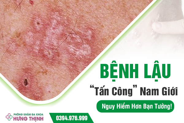 Bệnh Lậu “Tấn Công” Nam Giới: Nguy Hiểm Hơn Bạn Tưởng!