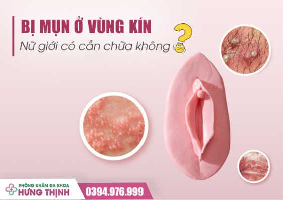 Bị Mụn Ở Vùng Kín: Nữ Giới Có Cần Chữa Không?