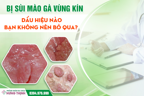 Bị Sùi Mào Gà Vùng Kín: Dấu Hiệu Nào Bạn Không Nên Bỏ Qua?