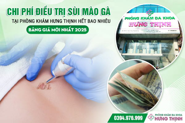 Chi Phí Điều Trị Sùi Mào Gà Tại Phòng Khám Hưng Thịnh Hết Bao Nhiêu? Bảng Giá Mới Nhất 2025