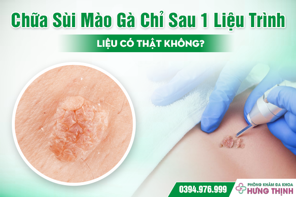 Chữa Sùi Mào Gà Chỉ Sau 1 Liệu Trình – Liệu Có Thật Không?
