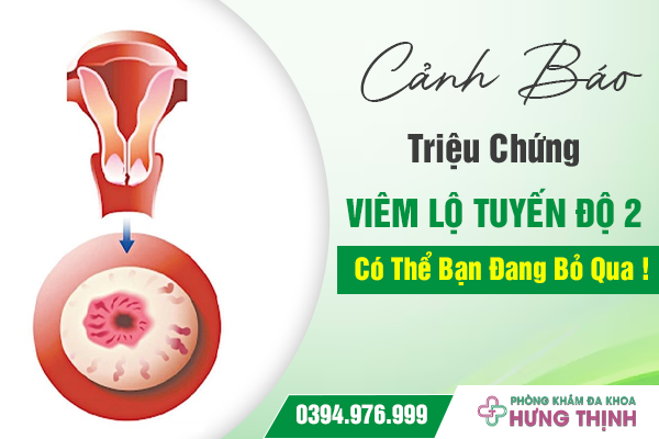 Cảnh Báo Triệu Chứng Viêm Lộ Tuyến Độ 2: Có Thể Bạn Đang Bỏ Qua !