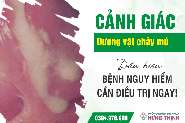 Cảnh giác: Dương vật chảy mủ - Dấu hiệu bệnh nguy hiểm cần điều trị ngay!