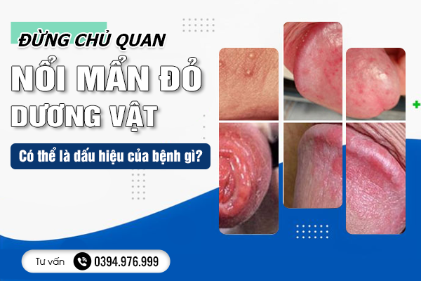 Đừng chủ quan- Nổi mẩn đỏ dương vật có thể là dấu hiệu của bệnh gì? 