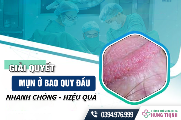 Giải quyết mụn ở bao quy đầu nhanh chóng - hiệu quả