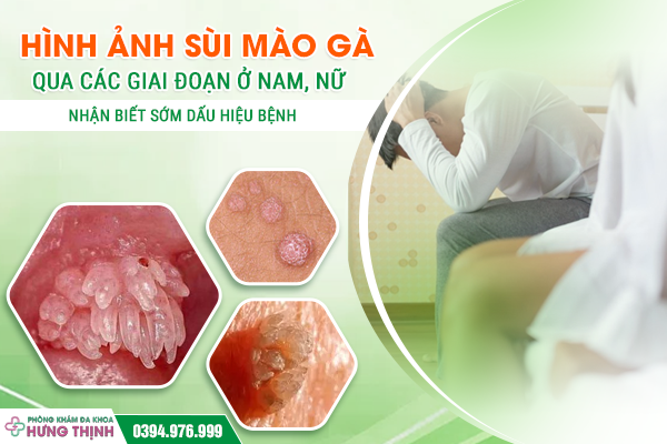 Hình Ảnh Sùi Mào Gà Qua Các Giai Đoạn Ở Nam, Nữ – Nhận Biết Sớm Dấu Hiệu Bệnh