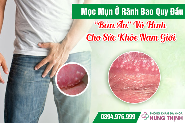 Mọc Mụn Ở Rãnh Bao Quy Đầu: “Bản Án” Vô Hình Cho Sức Khỏe Nam Giới
