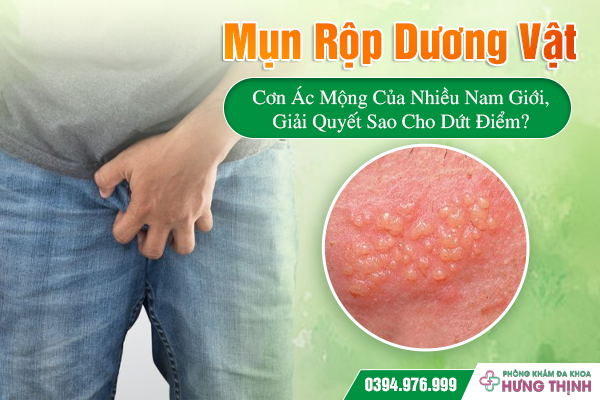 Mụn Rộp Dương Vật: Cơn Ác Mộng Của Nhiều Nam Giới, Giải Quyết Sao Cho Dứt Điểm?