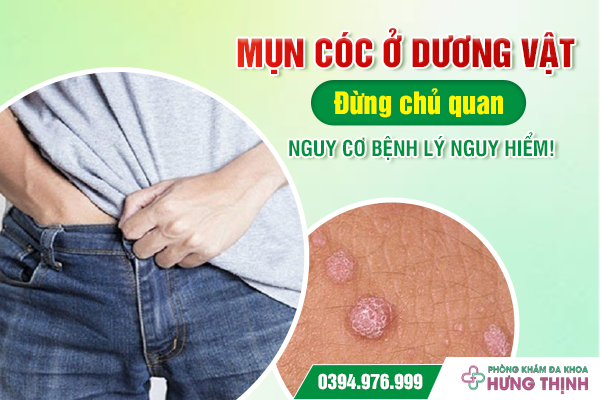 Mụn cóc ở dương vật: Đừng chủ quan, nguy cơ bệnh lý nguy hiểm!