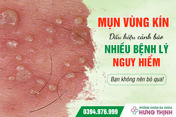 Mụn vùng kín: Dấu hiệu cảnh báo nhiều bệnh lý nguy hiểm bạn không nên bỏ qua!