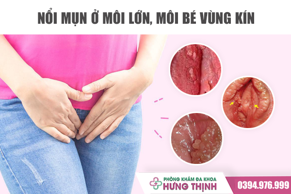 Nổi Mụn Ở Môi Vùng Kín - Tại Sao Nữ Giới Lại Xuất Hiện Tình Trạng Này?