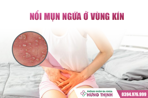 Nổi Mụn Ngứa Vùng Kín Nên Điều Trị Như Thế Nào? Những Sai Lầm Nữ Giới Hay Mắc Phải Khiến Tình Trạng Bệnh Nặng Thêm