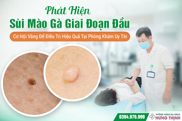 Phát Hiện Sùi Mào Gà Giai Đoạn Đầu: Cơ Hội Vàng Để Điều Trị Hiệu Quả Tại Phòng Khám Uy Tín