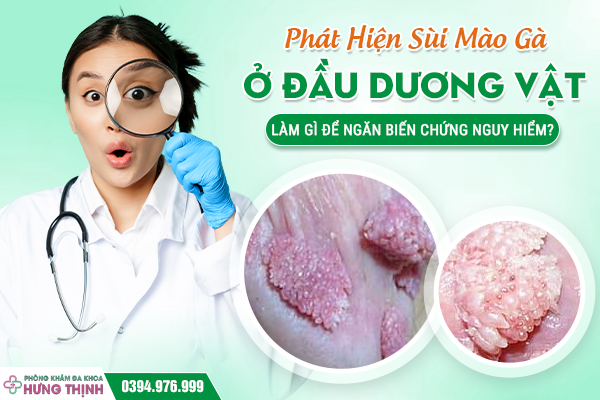 Phát Hiện Sùi Mào Gà Ở Đầu Dương Vật – Làm Gì Để Ngăn Biến Chứng Nguy Hiểm?