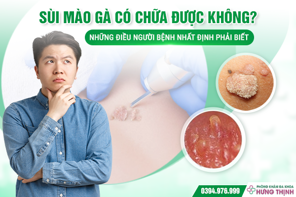 Sùi Mào Gà Có Chữa Được Không? Những Điều Người Bệnh Nhất Định Phải Biết