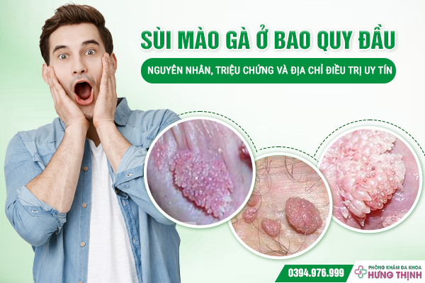 Sùi Mào Gà Ở Bao Quy Đầu: Nguyên Nhân, Triệu Chứng Và Địa Chỉ Điều Trị Uy Tín