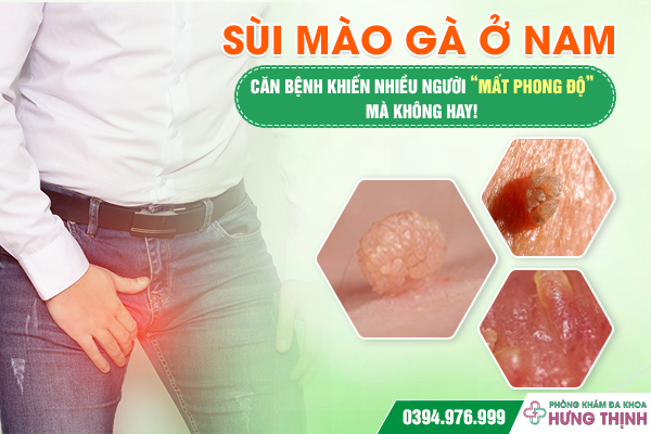 Sùi Mào Gà Ở Nam – Căn Bệnh Khiến Nhiều Người “Mất Phong Độ” Mà Không Hay!