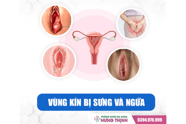 Sưng Ngứa Vùng Kín Có Sao Không? Nữ Giới Cần Làm Gì Để Giảm Bớt Tình Trạng Này?