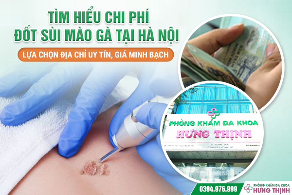 Tìm Hiểu Chi Phí Đốt Sùi Mào Gà Tại Hà Nội – Lựa Chọn Địa Chỉ Uy Tín, Giá Minh Bạch
