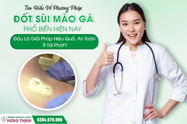 Tìm Hiểu Về Phương Pháp Đốt Sùi Mào Gà Phổ Biến Hiện Nay – Đâu Là Giải Pháp Hiệu Quả, An Toàn, Ít Tái Phát?