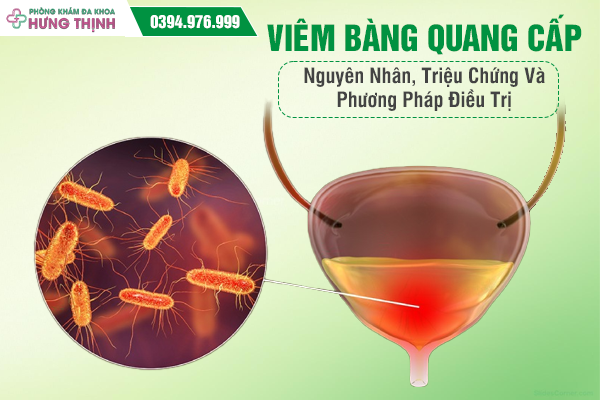 Viêm Bàng Quang Cấp: Nguyên Nhân, Triệu Chứng Và Phương Pháp Điều Trị