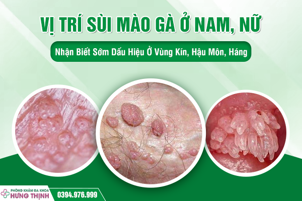 Vị Trí Sùi Mào Gà Ở Nam, Nữ: Nhận Biết Sớm Dấu Hiệu Ở Vùng Kín, Hậu Môn, Háng