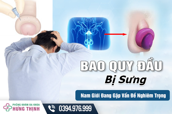 Bao Quy Đầu Bị Sưng - Nam Giới Đang Gặp Vấn Đề Nghiêm Trọng