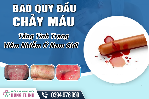 Bao Quy Đầu Chảy Máu - Nguyên Nhân Làm Tăng Tình Trạng Viêm Nhiễm Ở Nam Giới