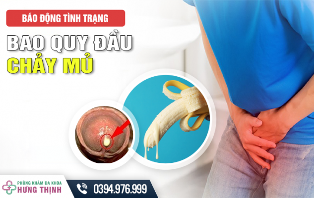 Báo Động Tình Trạng Bao Quy Đầu Chảy Mủ!