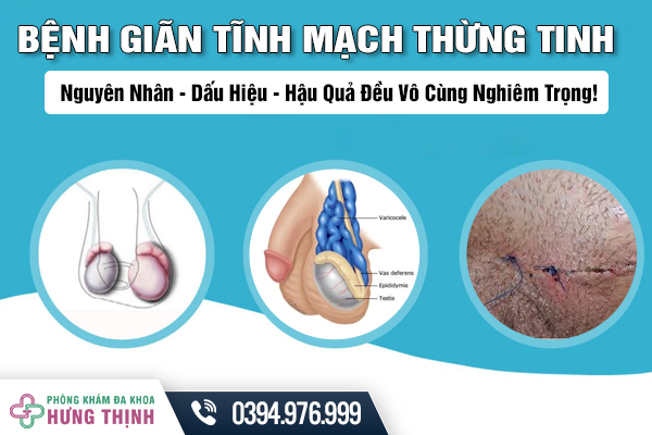 Bệnh Giãn Tĩnh Mạch Thừng Tinh: Nguyên Nhân - Dấu Hiệu - Hậu Quả Đều Vô Cùng Nghiêm Trọng!