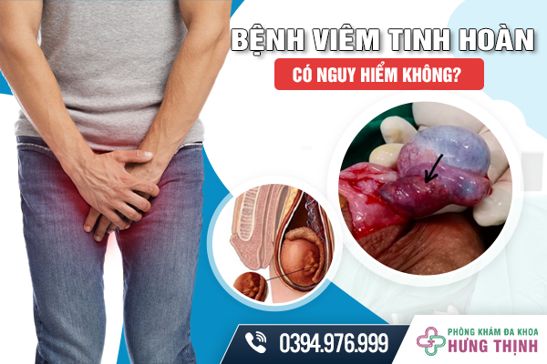 Bệnh Viêm Tinh Hoàn Có Nguy Hiểm Không?