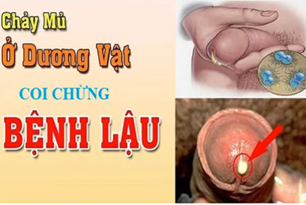 Dương vật chảy mủ là dấu hiệu bệnh gì