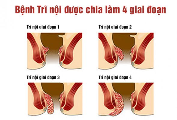 Nhận biết 4 cấp độ của bệnh trĩ và cách chữa trị hiệu quả