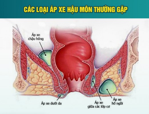 Áp xe hậu môn có tự khỏi không? tìm hiểu về áp xe hậu môn 