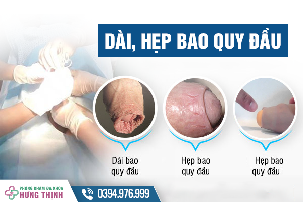 Những Thông Tin Về Dài Hẹp Bao Quy Đầu Không Phải Ai Cũng Biết!