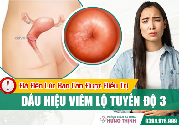 Dấu Hiệu Viêm Lộ Tuyến Độ 3: Đã Đến Lúc Bạn Cần Được Điều Trị - Đừng Chần Chừ Nữa!