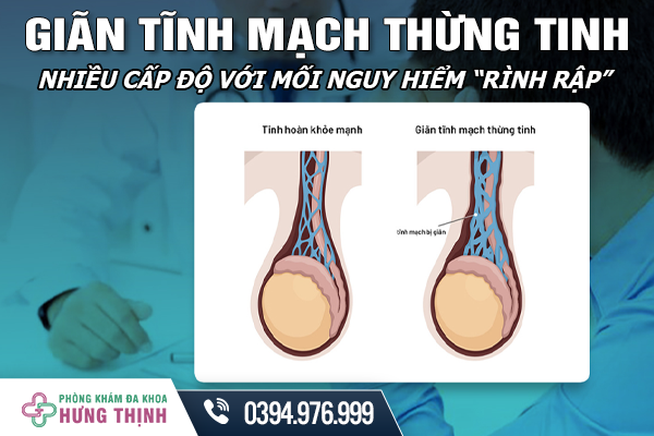 Giãn Tĩnh Mạch Thừng Tinh - Nhiều Cấp Độ Với Mối Nguy Hiểm “Rình Rập”