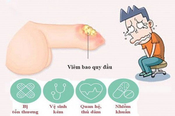 Ngứa bao quy đầu và cách chữa hiệu quả hiện nay 