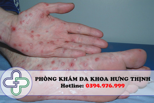 Những triệu chứng bệnh xã hội phổ biến