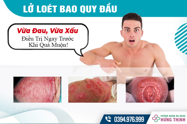 Lở Loét Bao Quy Đầu: Vừa Đau, Vừa Xấu - Điều Trị Ngay Trước Khi Quá Muộn!