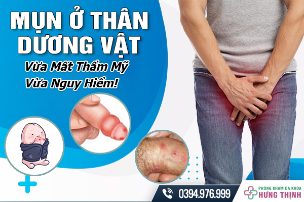 Mụn Ở Thân Dương Vật - Vừa Mất Thẩm Mỹ, Vừa Nguy Hiểm!